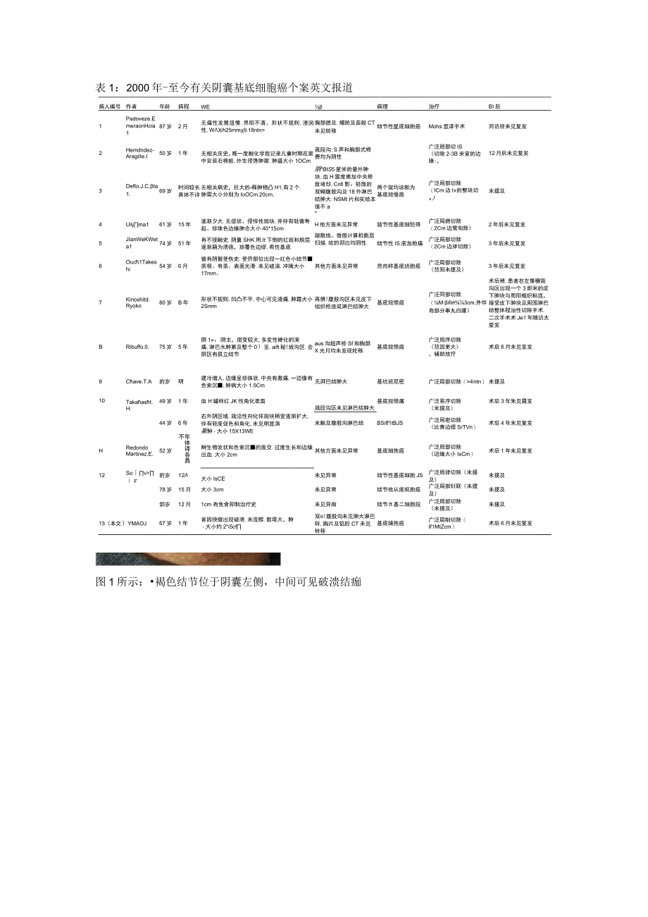 阴囊基底细胞癌1例并文献复习.docx_第2页