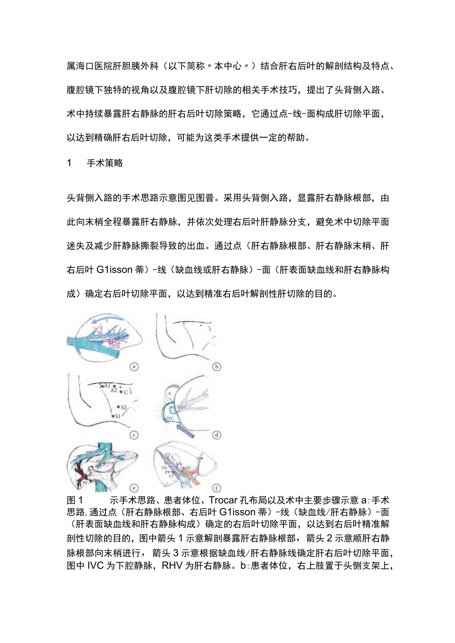 最新：头背侧入路腹腔镜肝右后叶切除策略.docx_第2页