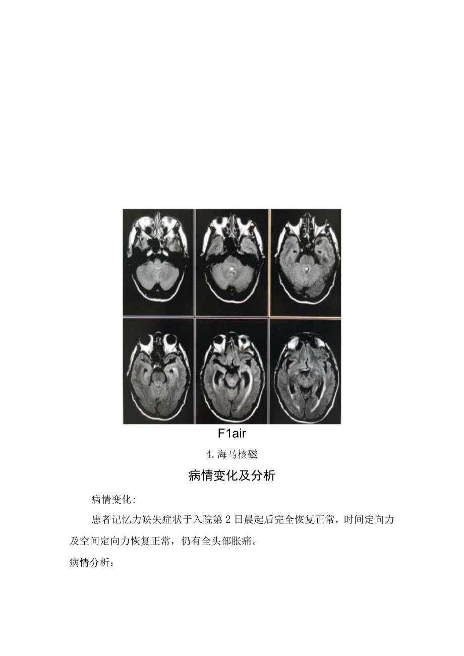 临床短暂性全面性遗忘临床表现、诊断标准、发病机制、病例分享及分析.docx_第3页