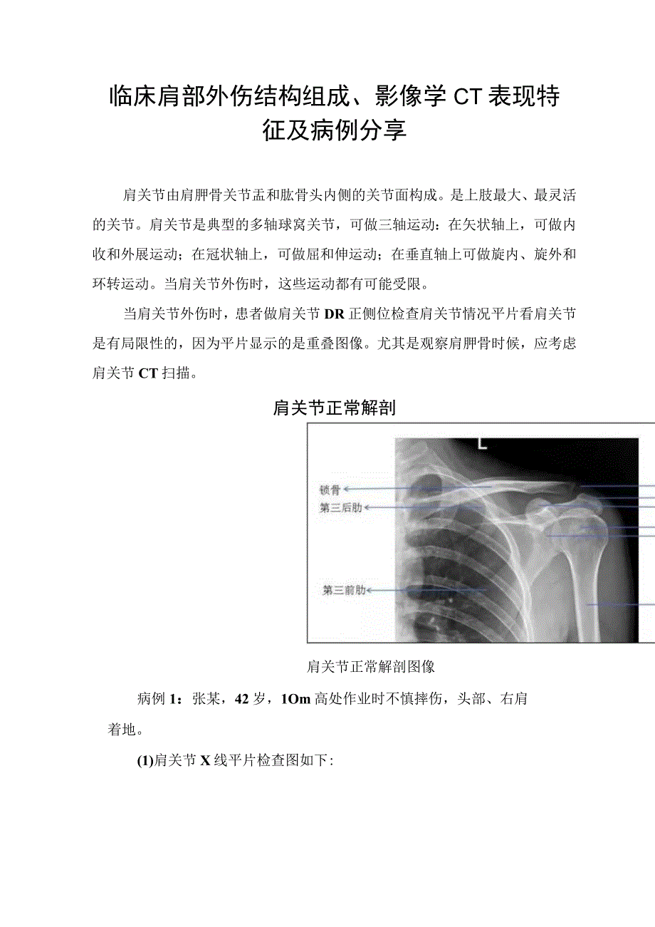 临床肩部外伤结构组成、影像学CT表现特征及病例分享.docx_第1页