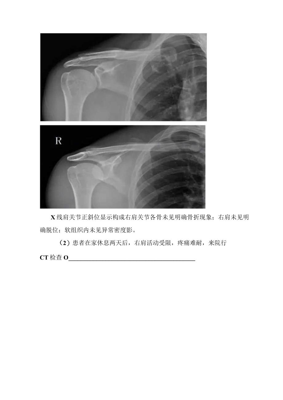 临床肩部外伤结构组成、影像学CT表现特征及病例分享.docx_第2页