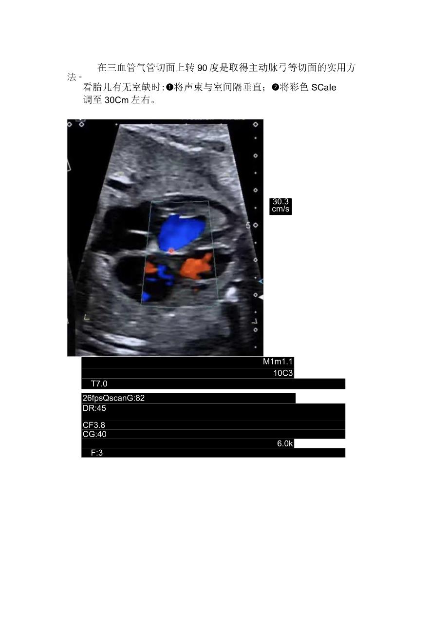 临床胎儿心脏清晰图像注意事项和影像学表现.docx_第2页