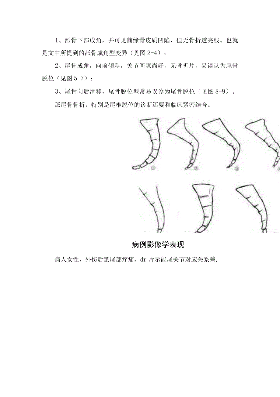 临床骨科鱼钩骨折弯曲形态、误诊注意事项及病例分析.docx_第2页