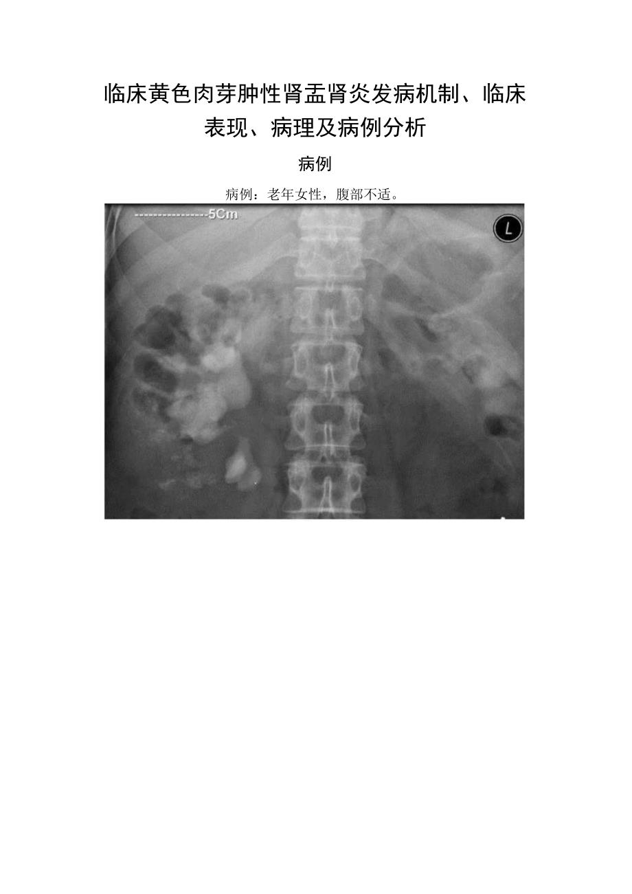 临床黃色肉芽肿性肾盂肾炎发病机制、临床表现、病理及病例分析.docx_第1页