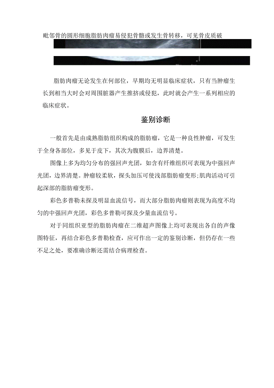 临床软组织脂肪肉瘤超声表现、超声诊断及鉴别诊断.docx_第2页