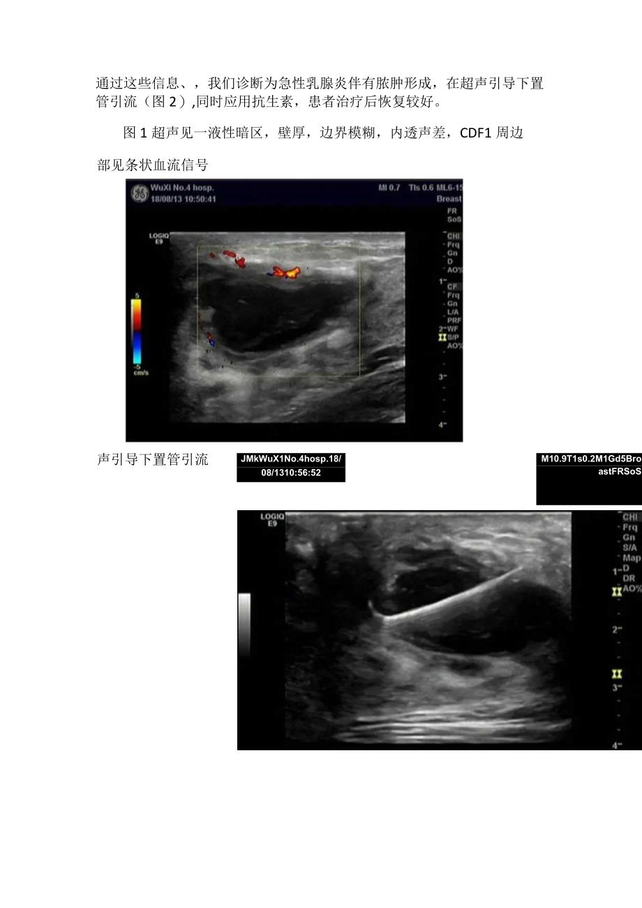 临床急、慢性乳腺炎超声诊断观察、影像学表现及病例分享.docx_第2页