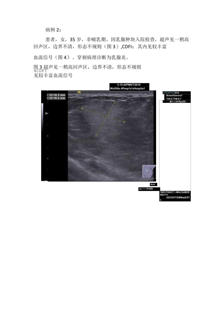 临床急、慢性乳腺炎超声诊断观察、影像学表现及病例分享.docx_第3页