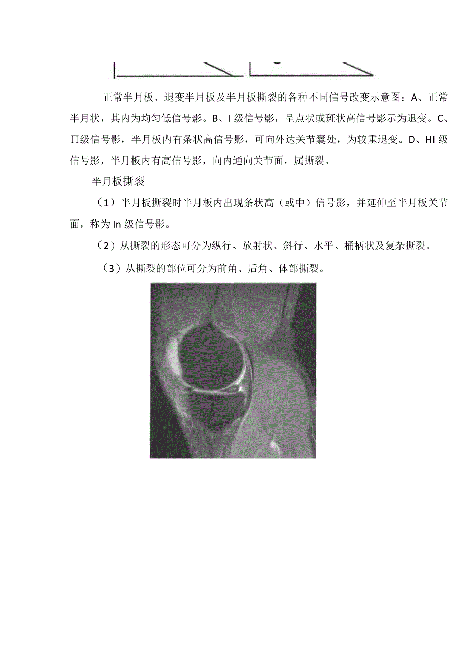 临床膝关节半月板损伤形态、信号、撕裂临床表现、鉴别诊断及盘状半月板影像征象.docx_第2页