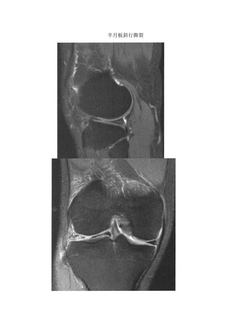 临床膝关节半月板损伤形态、信号、撕裂临床表现、鉴别诊断及盘状半月板影像征象.docx_第3页