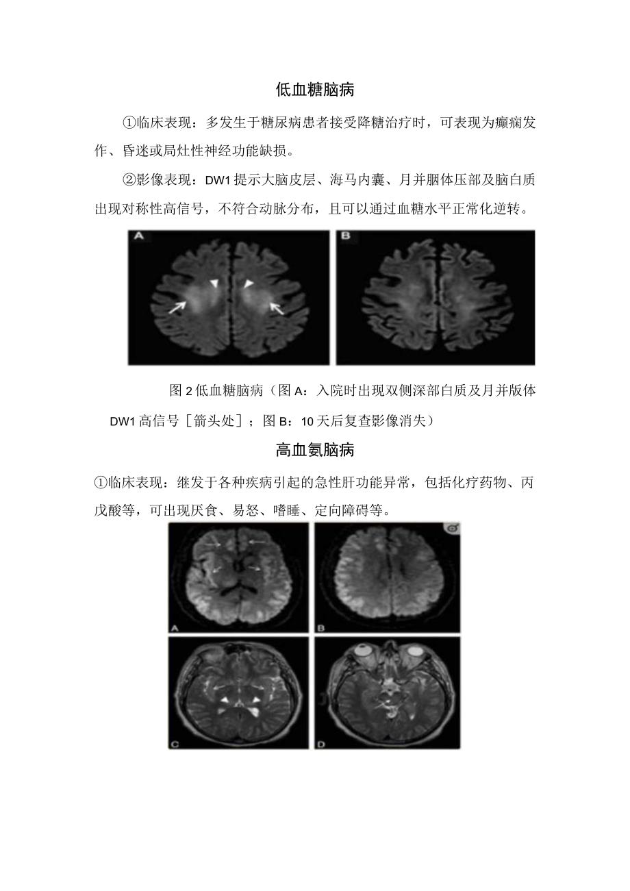 线粒体脑肌病伴高乳酸血症和卒中样发作、低血糖脑病、高血氨脑病、炎症及感染相关疾病、神经元内核包涵体病、血管性疾病等弥漫性皮层病变.docx_第2页