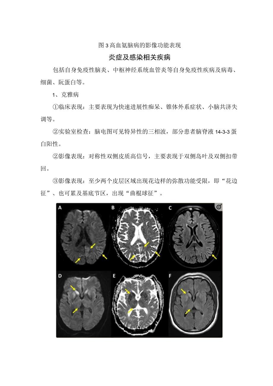 线粒体脑肌病伴高乳酸血症和卒中样发作、低血糖脑病、高血氨脑病、炎症及感染相关疾病、神经元内核包涵体病、血管性疾病等弥漫性皮层病变.docx_第3页