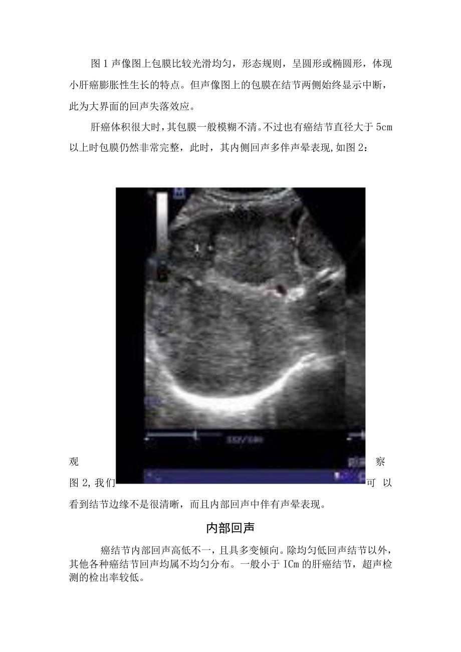 肝癌影像学检查包膜、内部回声及彩色多普勒超声诊断.docx_第2页