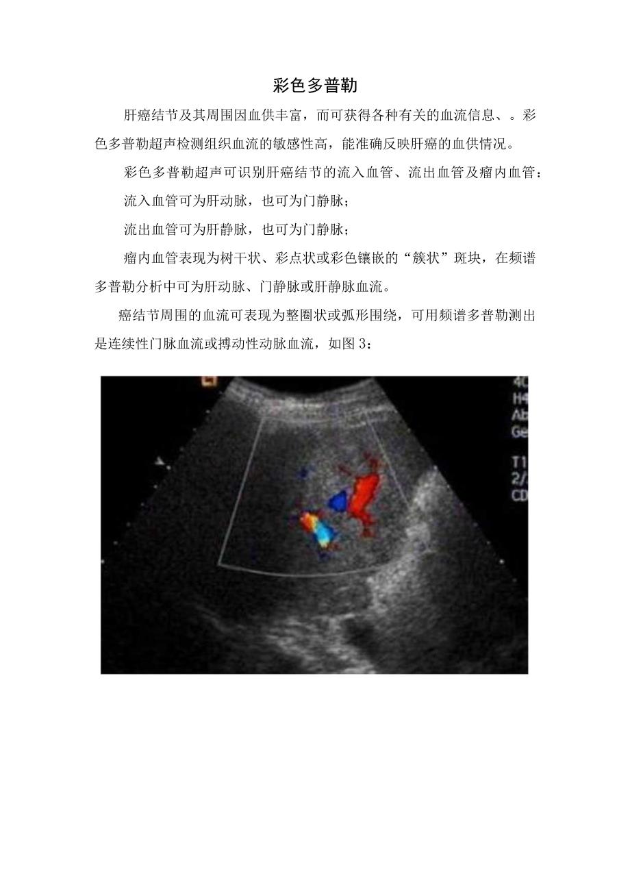 肝癌影像学检查包膜、内部回声及彩色多普勒超声诊断.docx_第3页