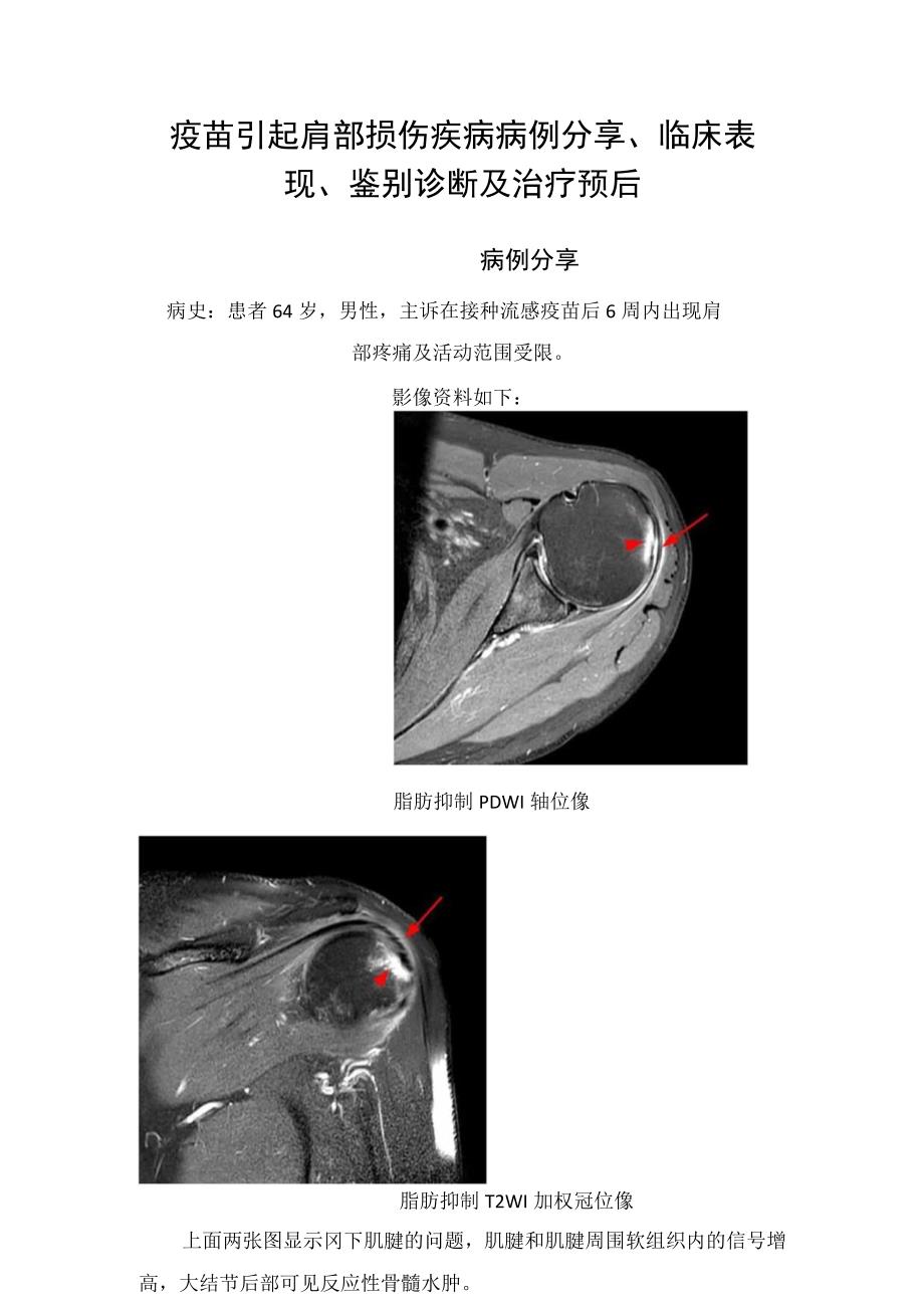 疫苗引起肩部损伤疾病病例分享、临床表现、鉴别诊断及治疗预后.docx_第1页