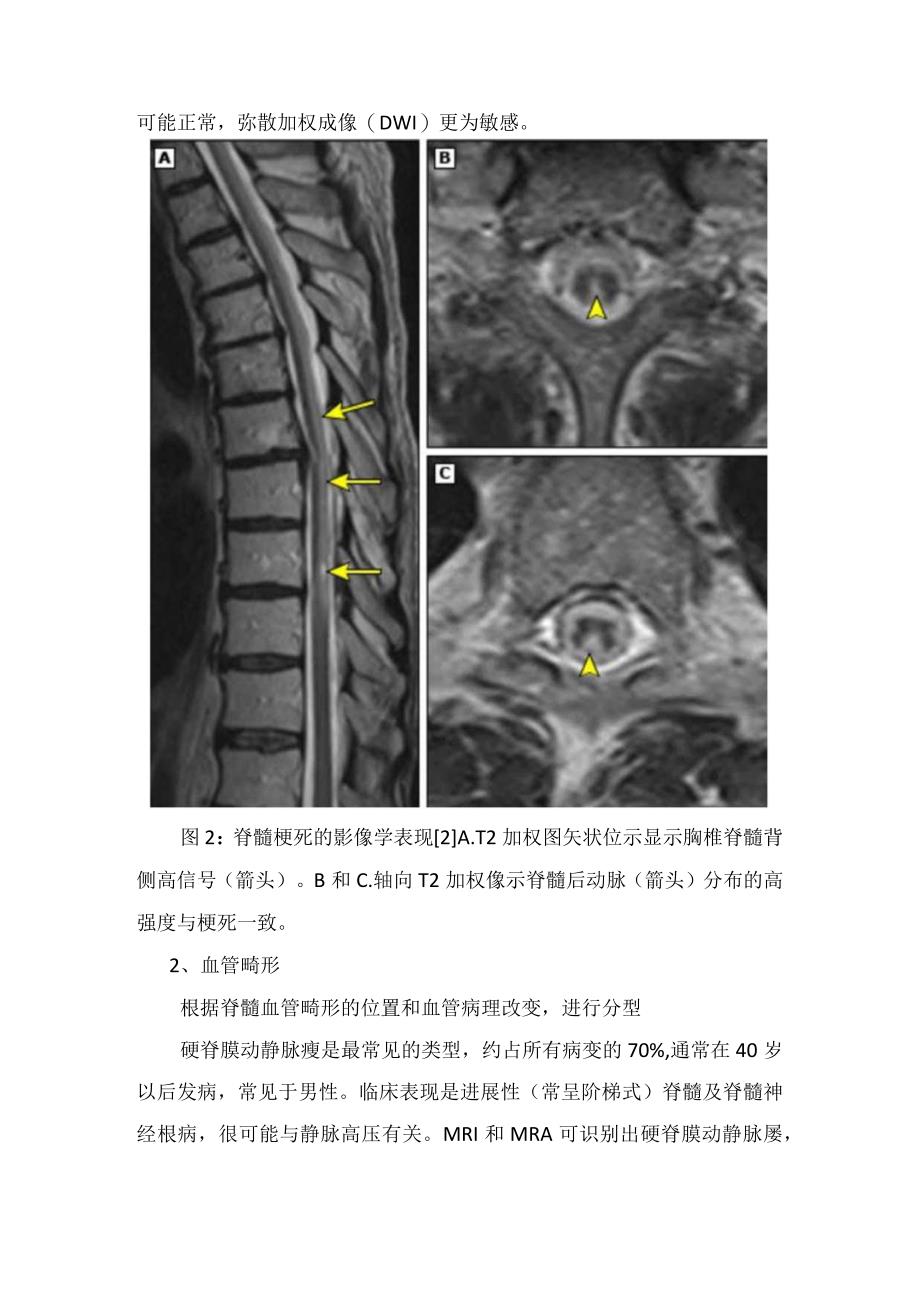 炎症性感染性血管性中毒性及代谢性脊髓病肿瘤等脊髓相关疾病临床表现.docx_第3页