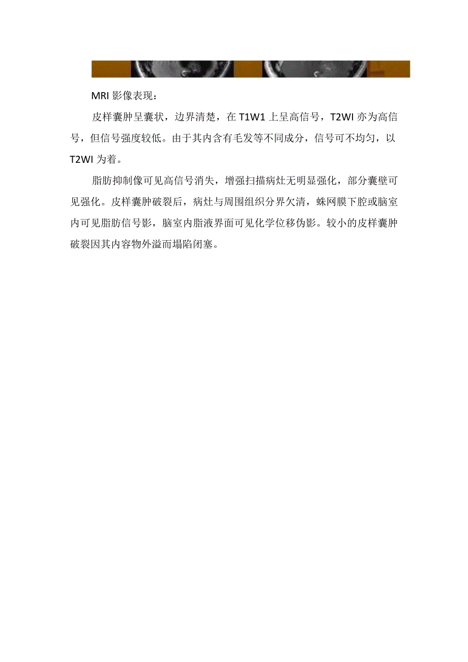 表皮样囊肿与皮样囊肿临床表现发病机制及影像学特征.docx_第3页