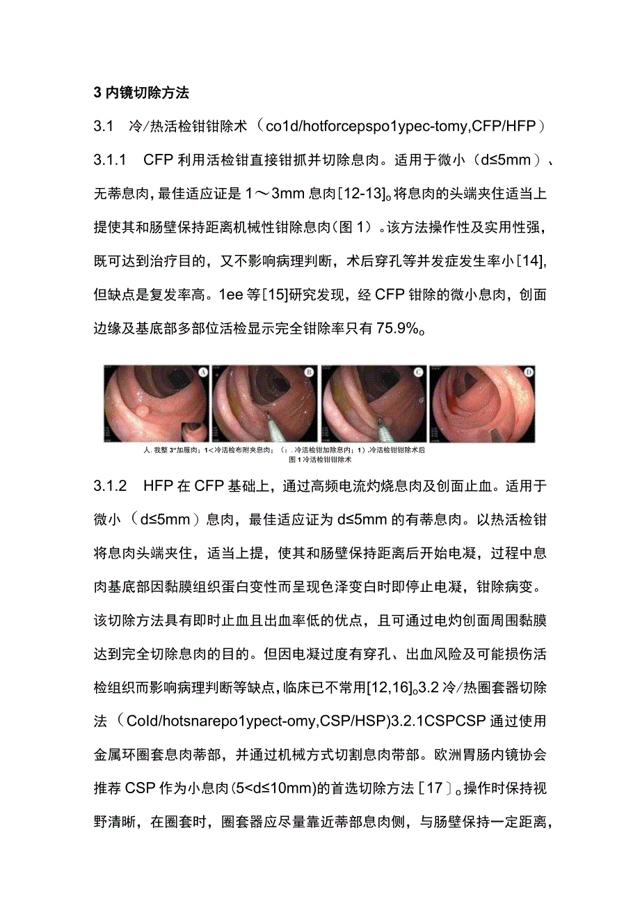 2023儿童结直肠息肉内镜下切除方法选择原则（全文）.docx_第3页