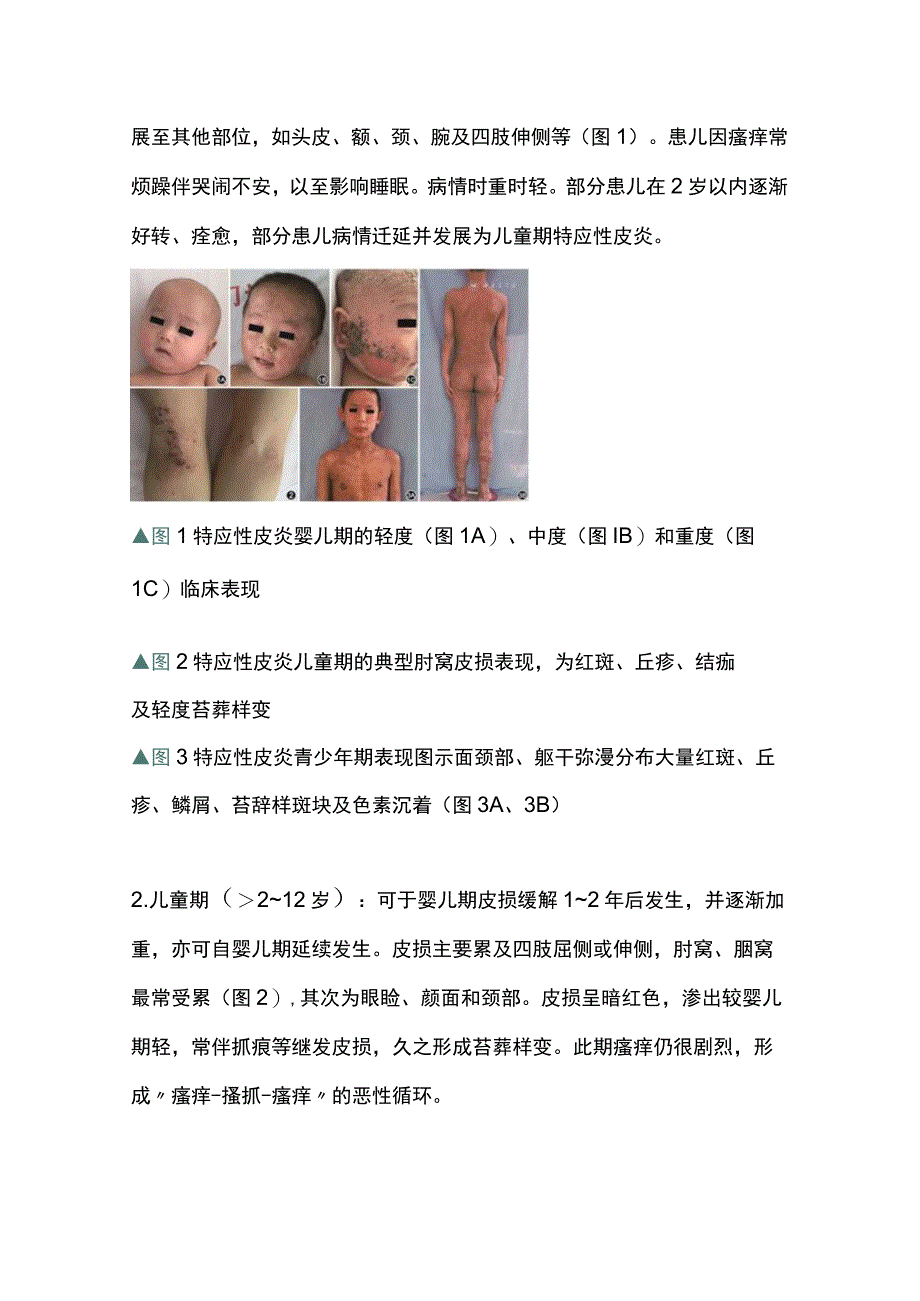 2023儿童特应性皮炎基层诊疗指南（最全版）.docx_第3页