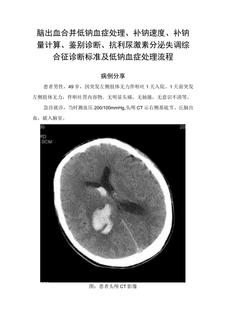 脑出血合并低钠血症处理、补钠速度、补钠量计算、鉴别诊断、抗利尿激素分泌失调综合征诊断标准及低钠血症处理流程.docx_第1页