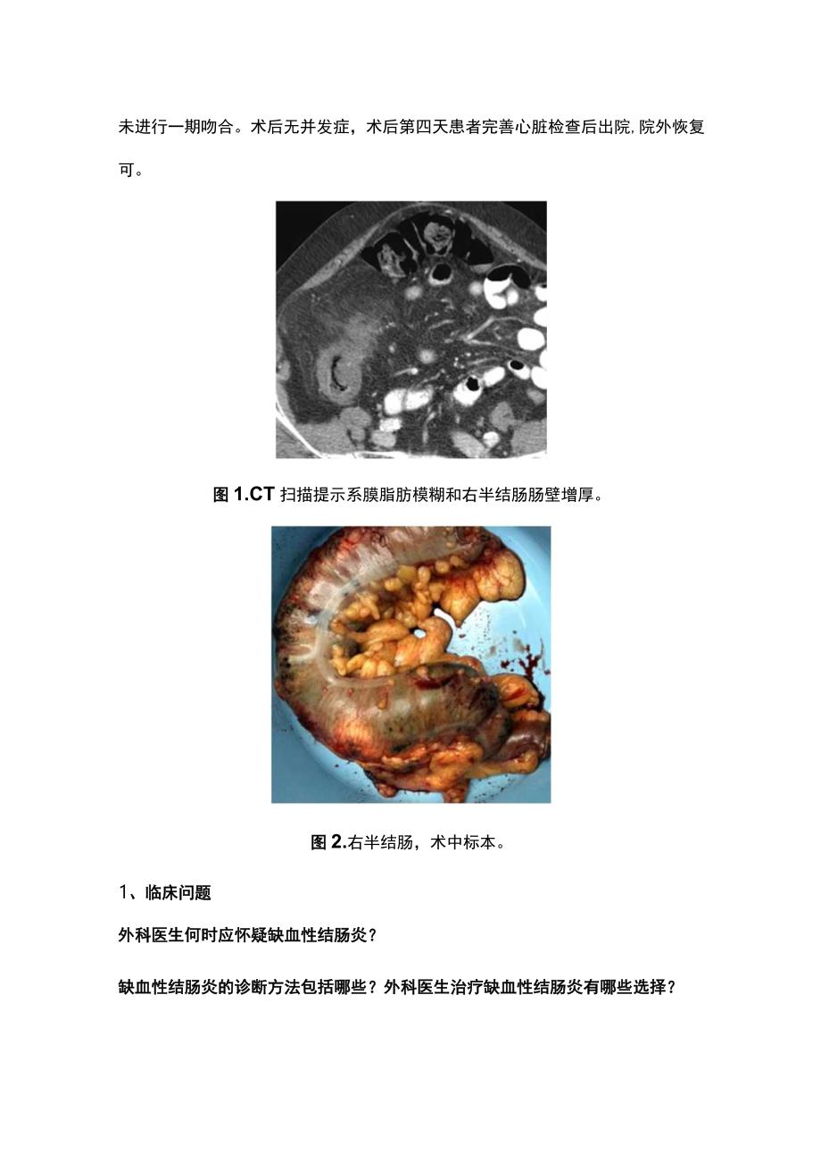 最新：缺血性结肠炎的诊断和治疗.docx_第2页