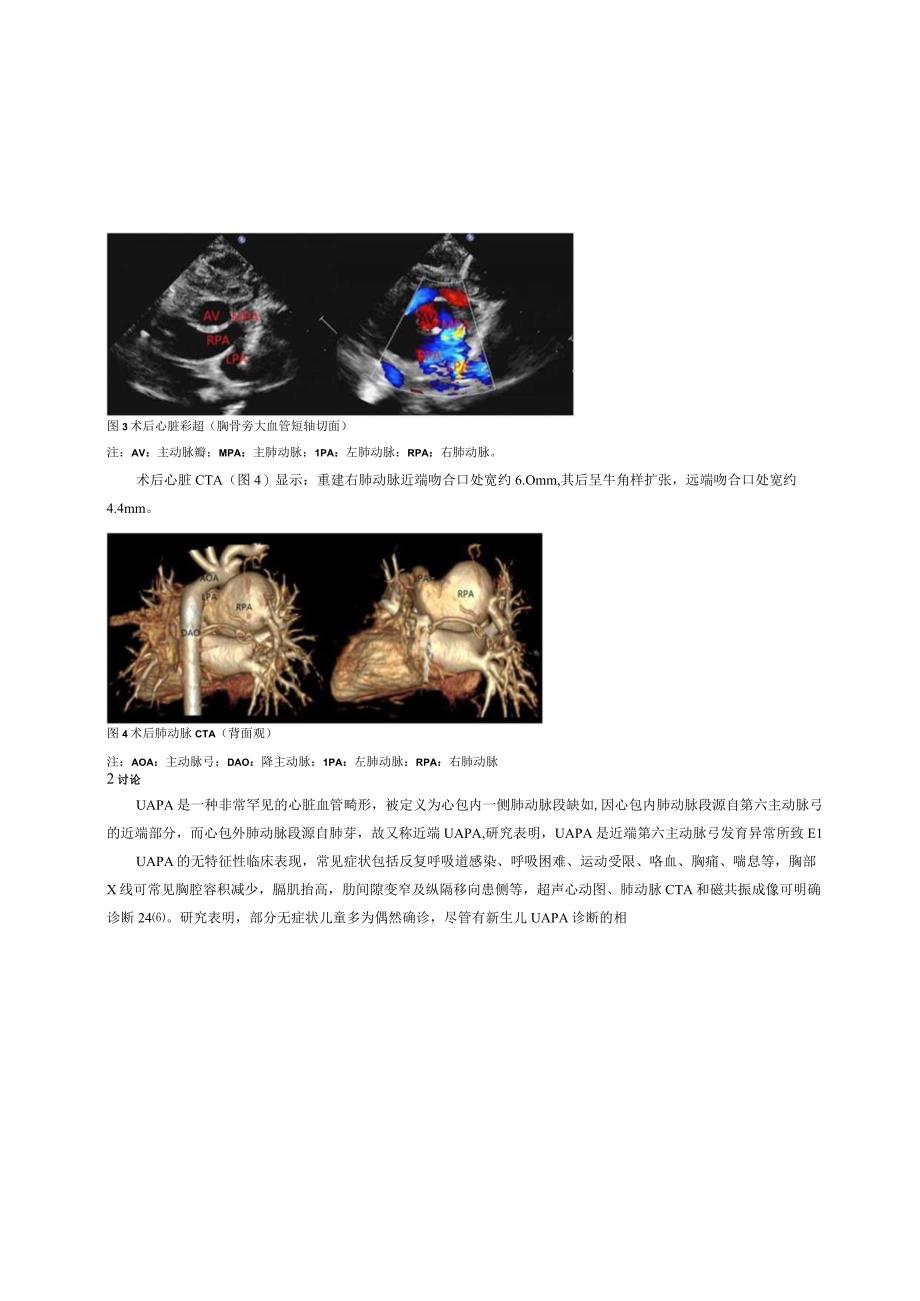 非体外循环下先天性右肺动脉缺如矫治一例并文献复习修改见批注！.docx_第3页