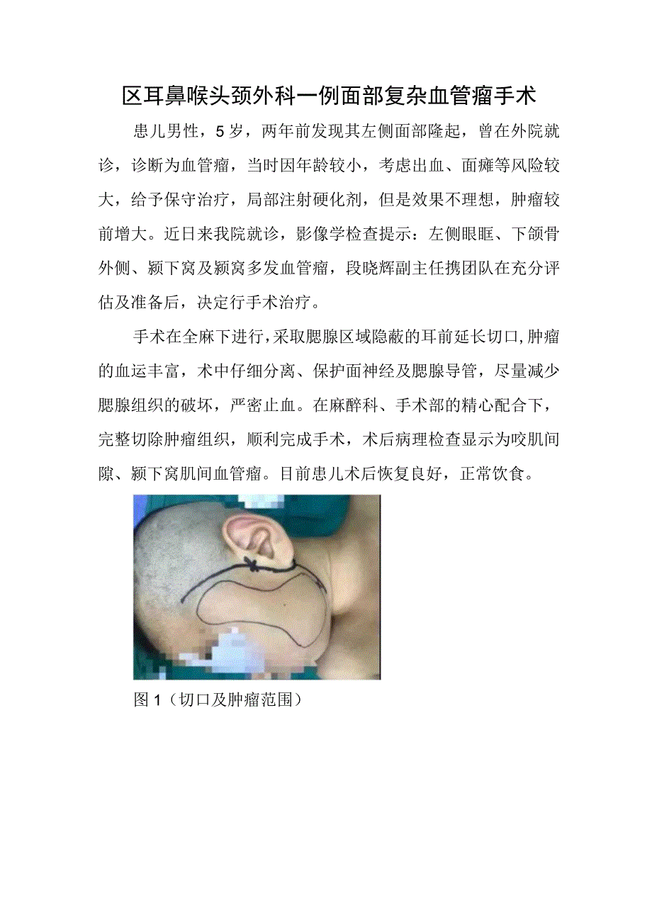 区耳鼻喉头颈外科一例面部复杂血管瘤手术.docx_第1页