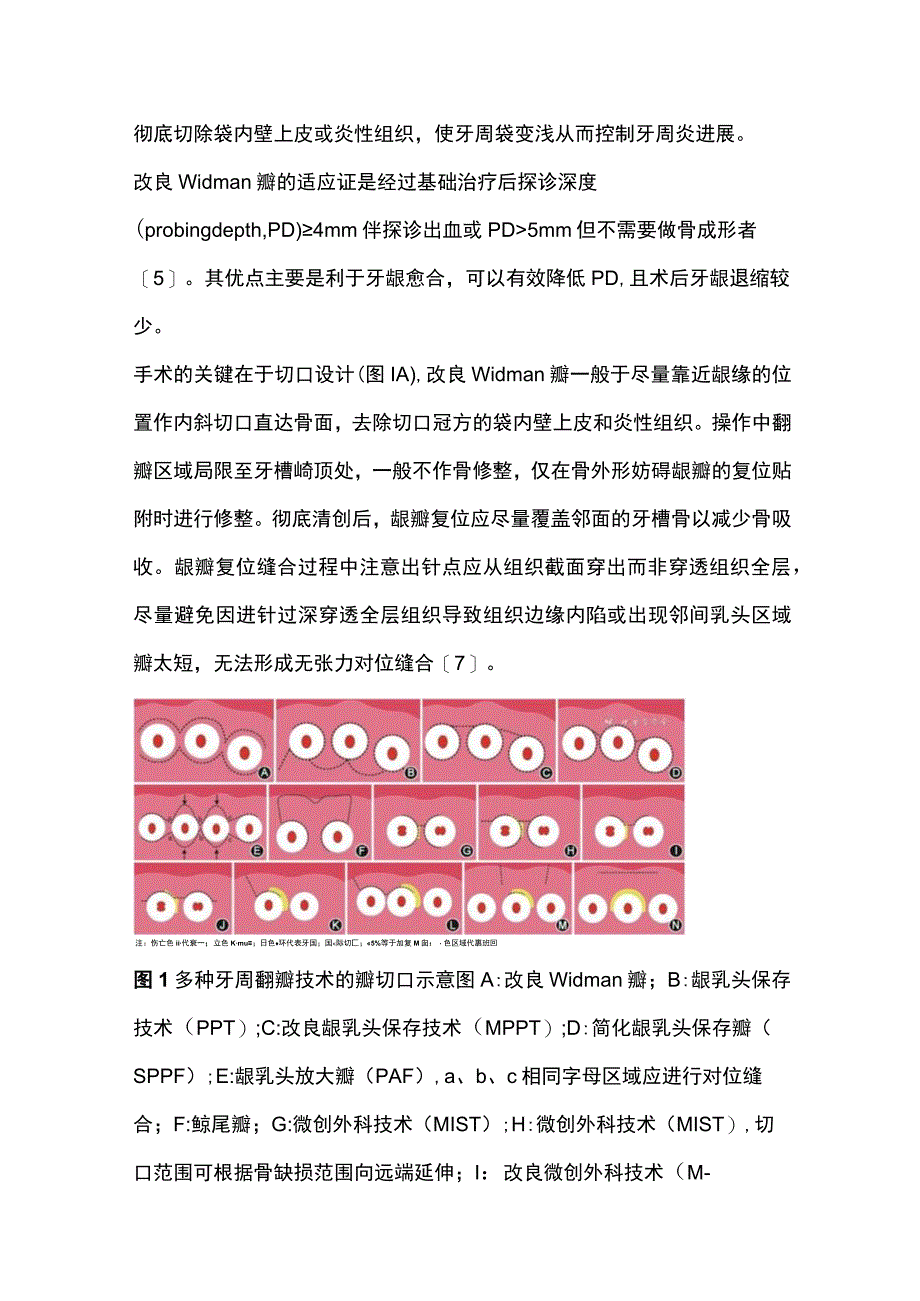 2023保存龈乳头牙周翻瓣术的研究进展.docx_第2页