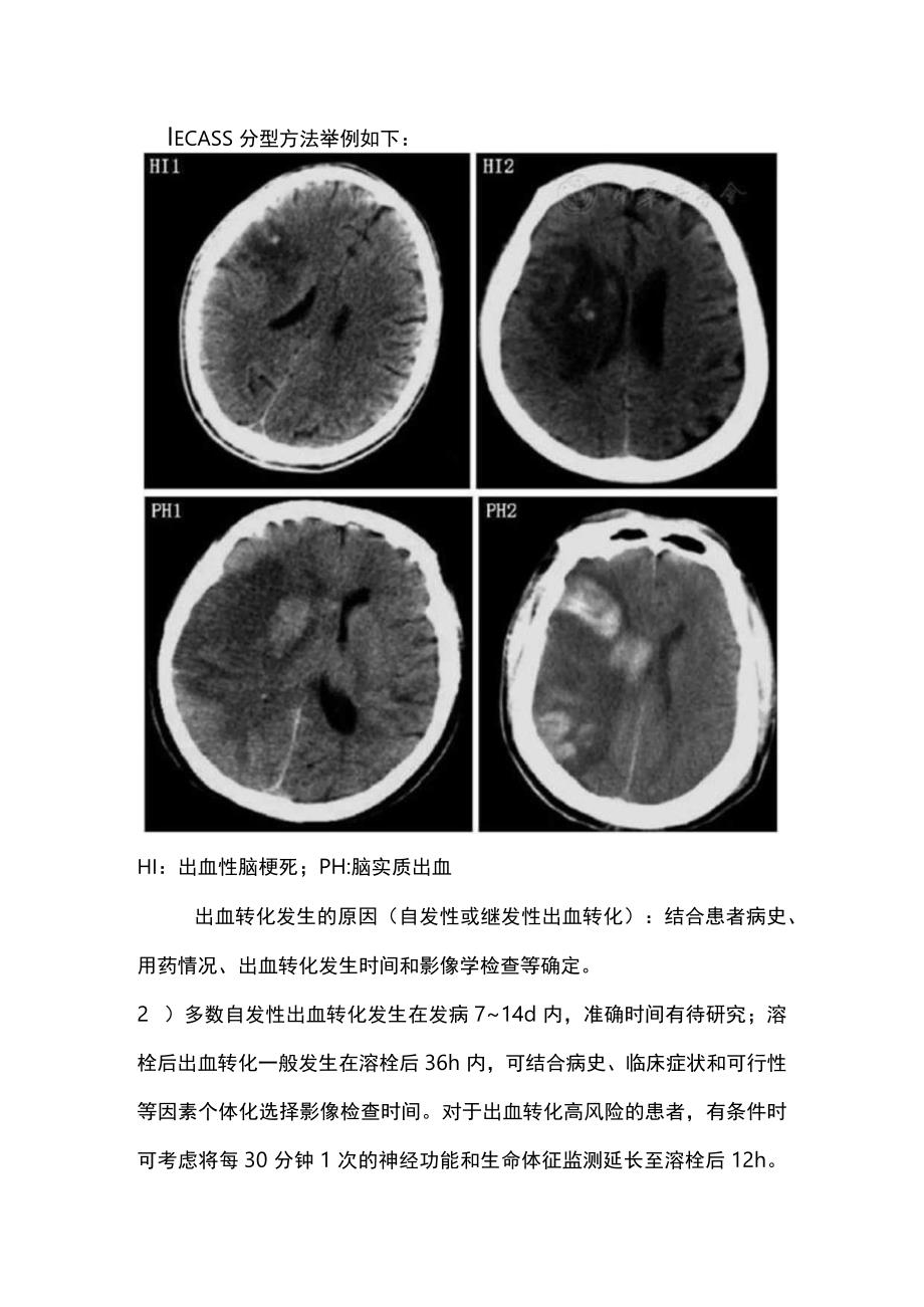 2023中国急性脑梗死后出血诊治专家共识要点.docx_第2页