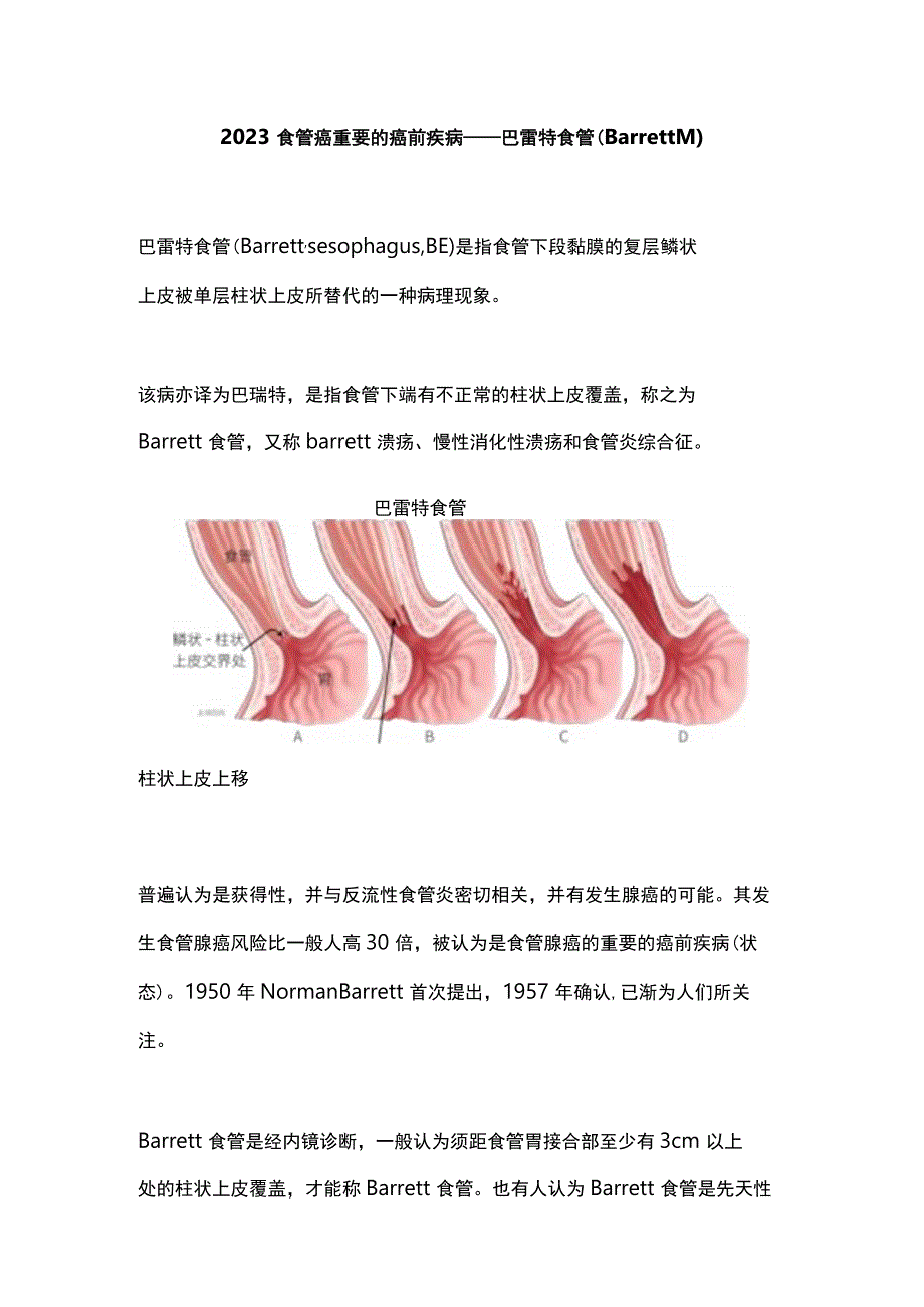 2023食管癌重要的癌前疾病——巴雷特食管（Barrett’s）.docx_第1页