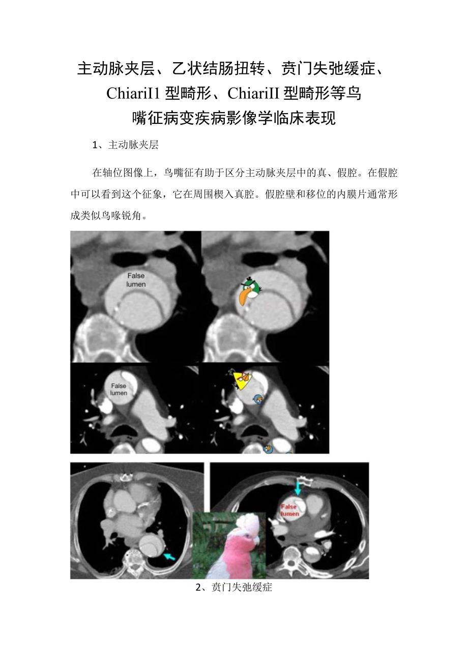 主动脉夹层、乙状结肠扭转、贲门失弛缓症、Chiari II型畸形、Chiari II型畸形等鸟嘴征病变疾病影像学临床表现.docx_第1页