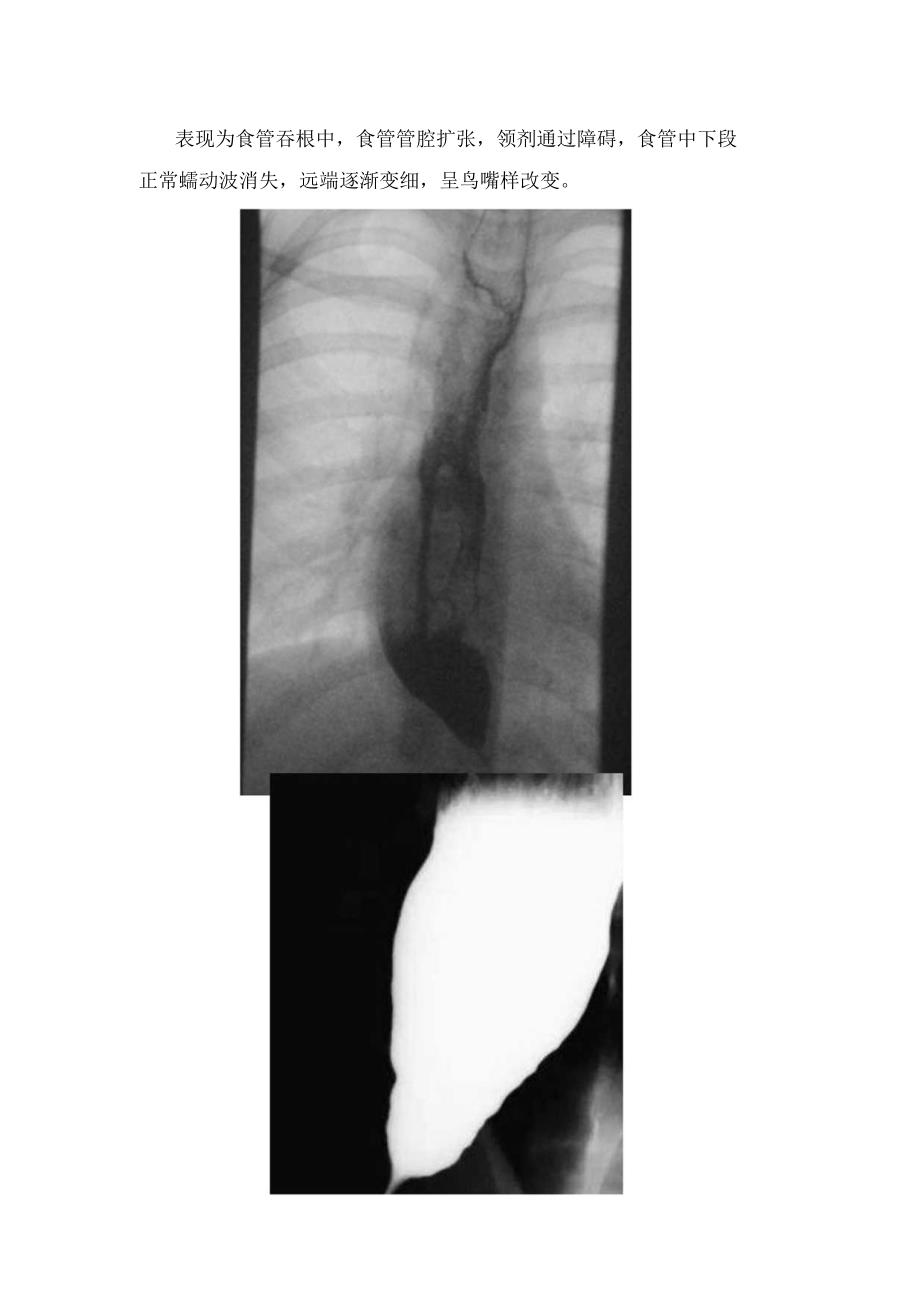 主动脉夹层、乙状结肠扭转、贲门失弛缓症、Chiari II型畸形、Chiari II型畸形等鸟嘴征病变疾病影像学临床表现.docx_第2页