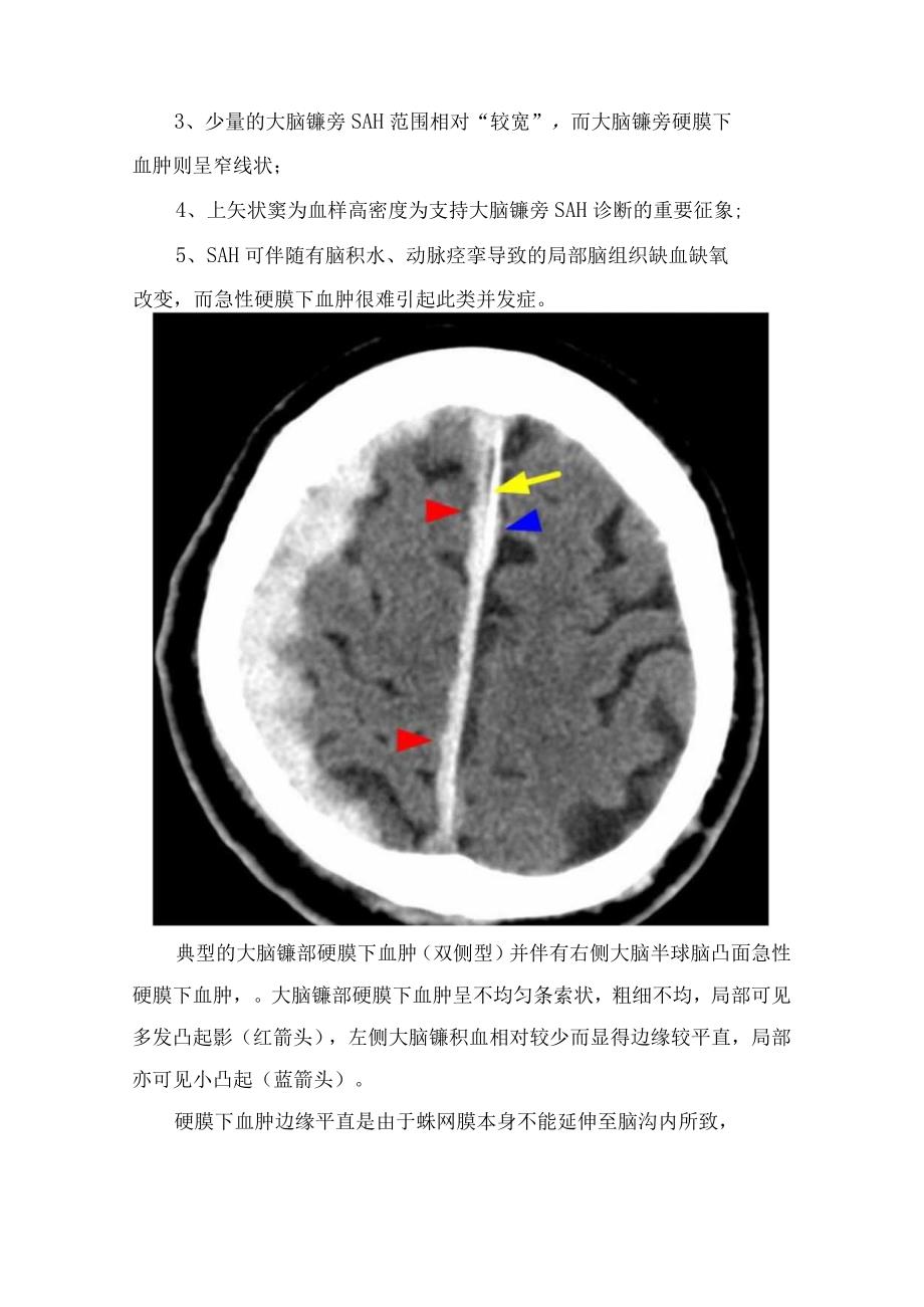 临床神经内科大脑镰旁急性硬膜下血肿和蛛网膜下腔出血主要鉴别及影像学表现.docx_第2页