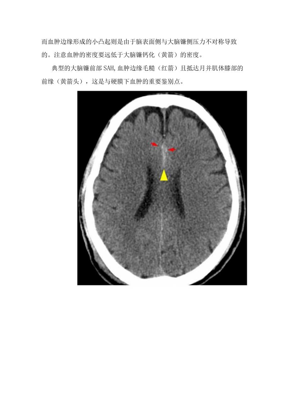 临床神经内科大脑镰旁急性硬膜下血肿和蛛网膜下腔出血主要鉴别及影像学表现.docx_第3页