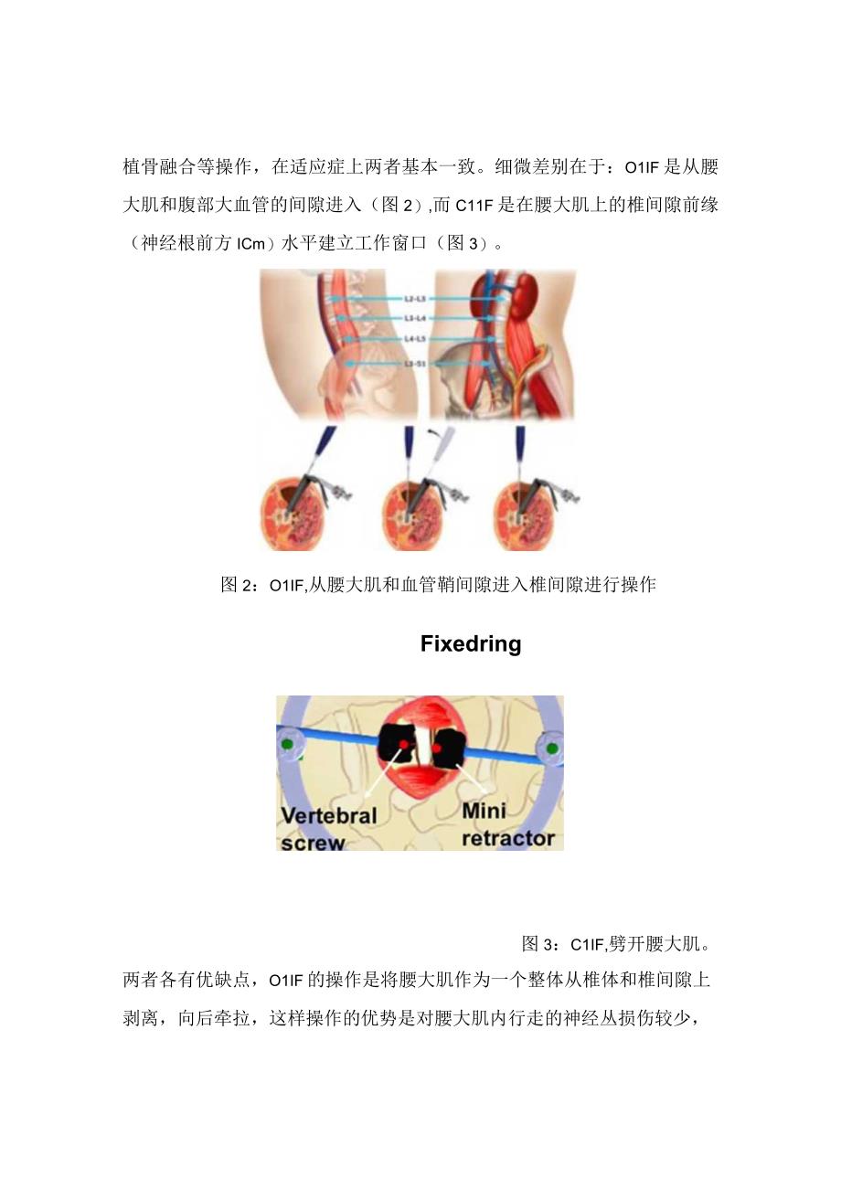 腰椎融合技术之OLIF技术起源、适应症及手术入路选择.docx_第3页