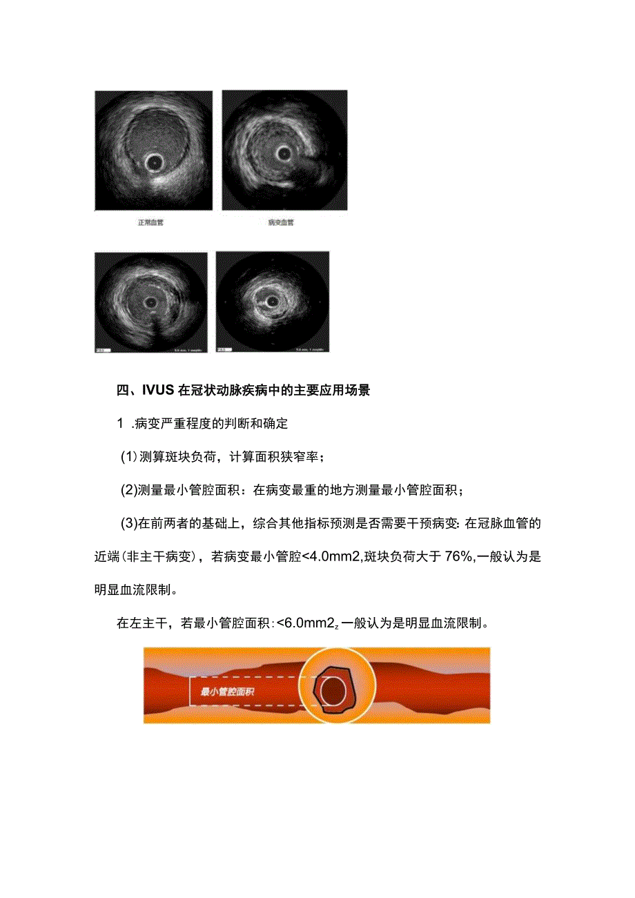 最新：IVUS血管内超声.docx_第3页