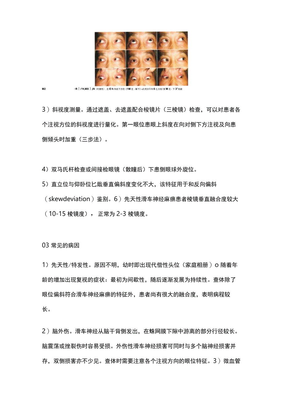 2023滑车神经麻痹诊断要点.docx_第2页