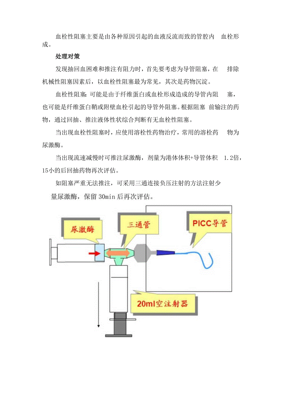 临床完全植入式静脉给药装置分类、导管阻塞原因分析、处理对策及堵管处理流程.docx_第2页