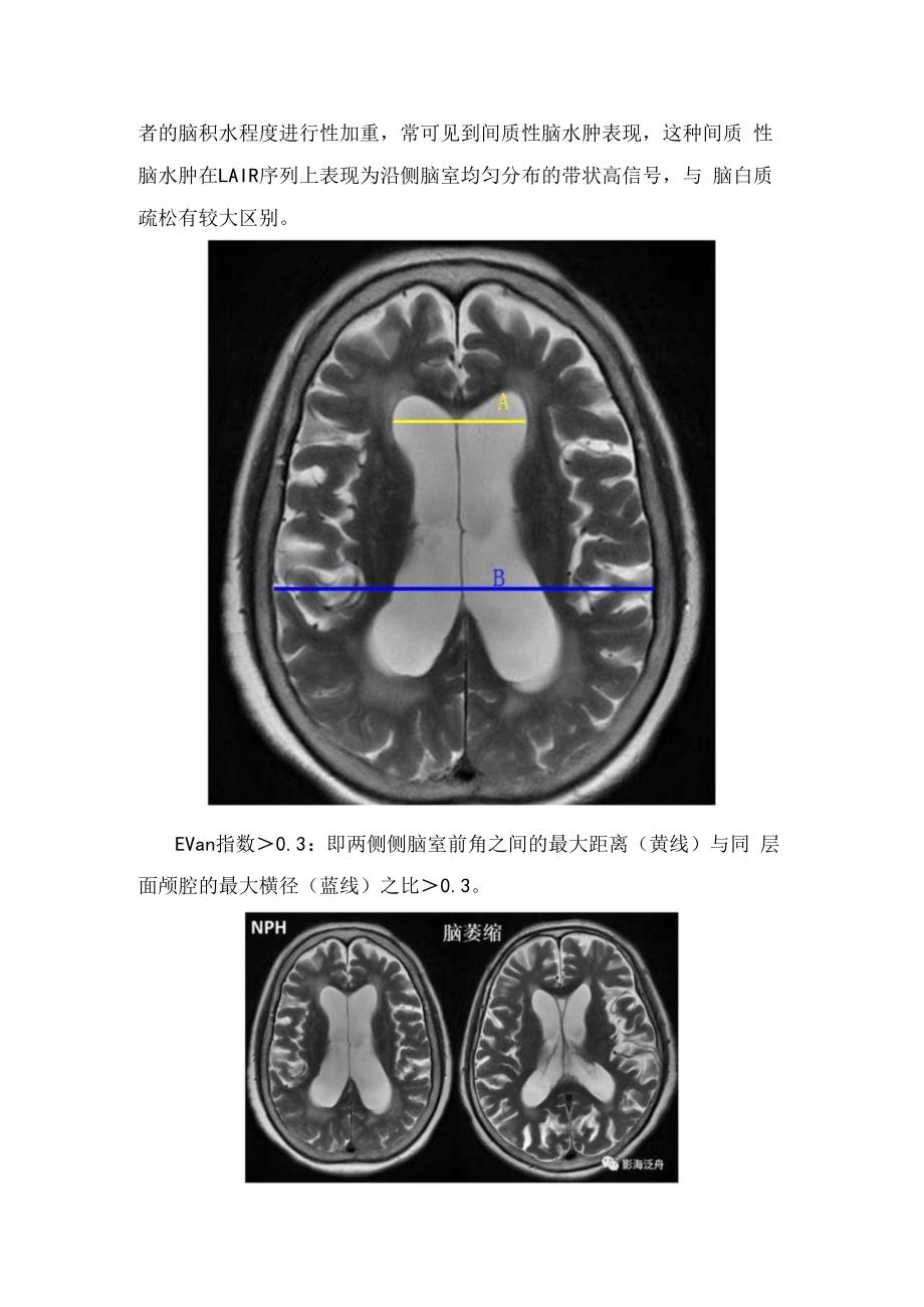 临床正常压力性脑积水病理、分类、影像学表现及诊断要点.docx_第2页