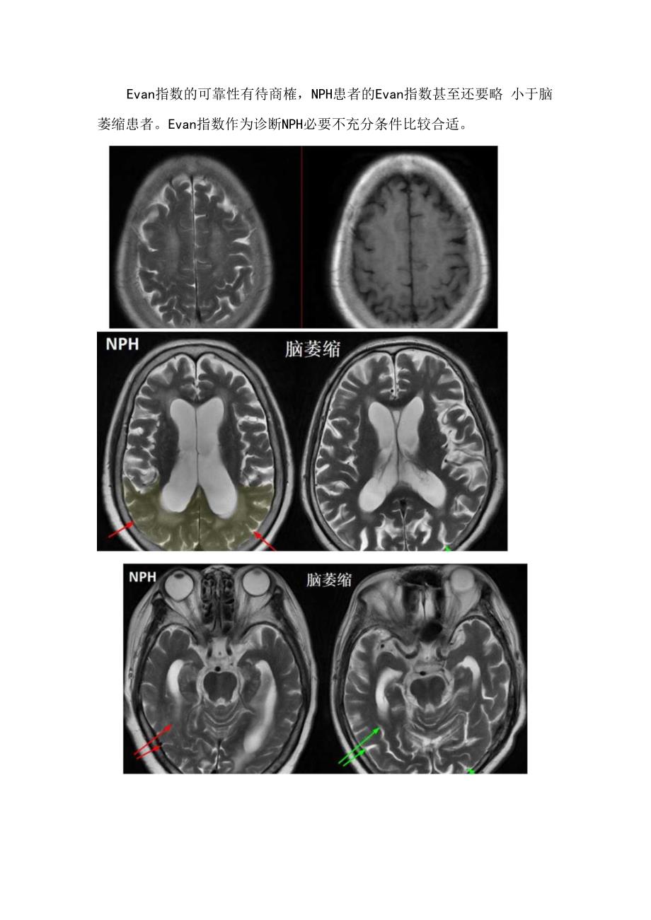 临床正常压力性脑积水病理、分类、影像学表现及诊断要点.docx_第3页