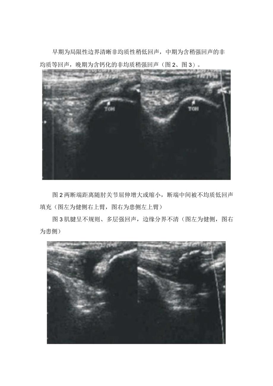 肱三头肌肌腱断裂伴骨化性肌炎、声像图特点、超声诊断及病例分享.docx_第2页