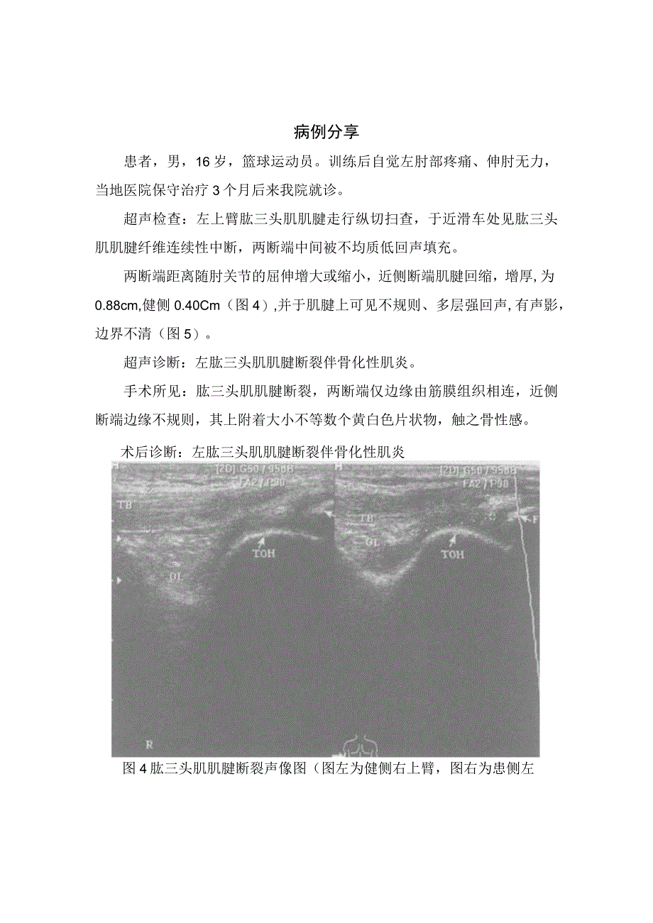 肱三头肌肌腱断裂伴骨化性肌炎、声像图特点、超声诊断及病例分享.docx_第3页