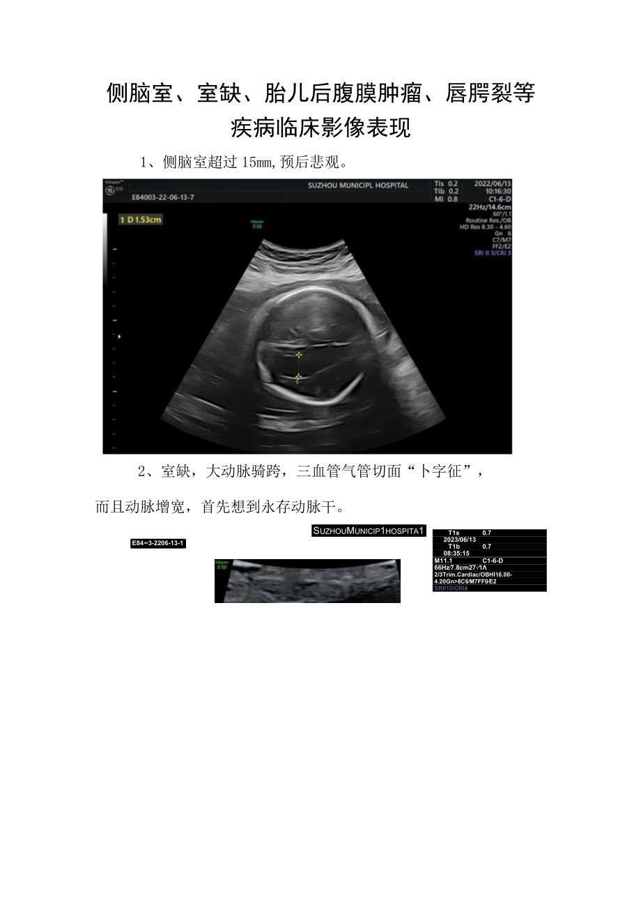 侧脑室、室缺、胎儿后腹膜肿瘤、唇腭裂等疾病临床影像表现.docx_第1页