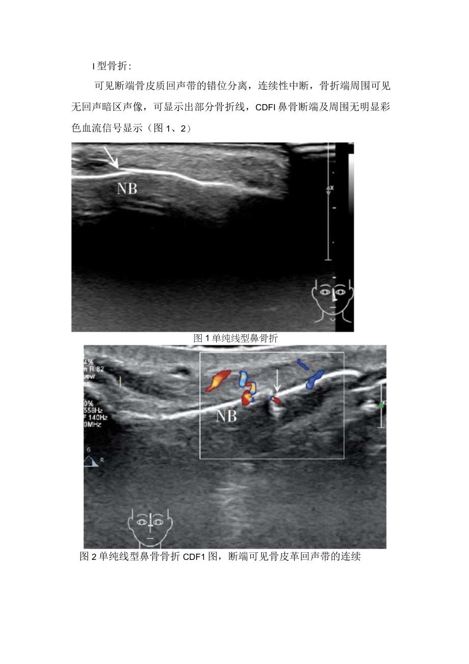 鼻骨骨折发生原因检查方法骨折分型及超声表现诊断.docx_第2页