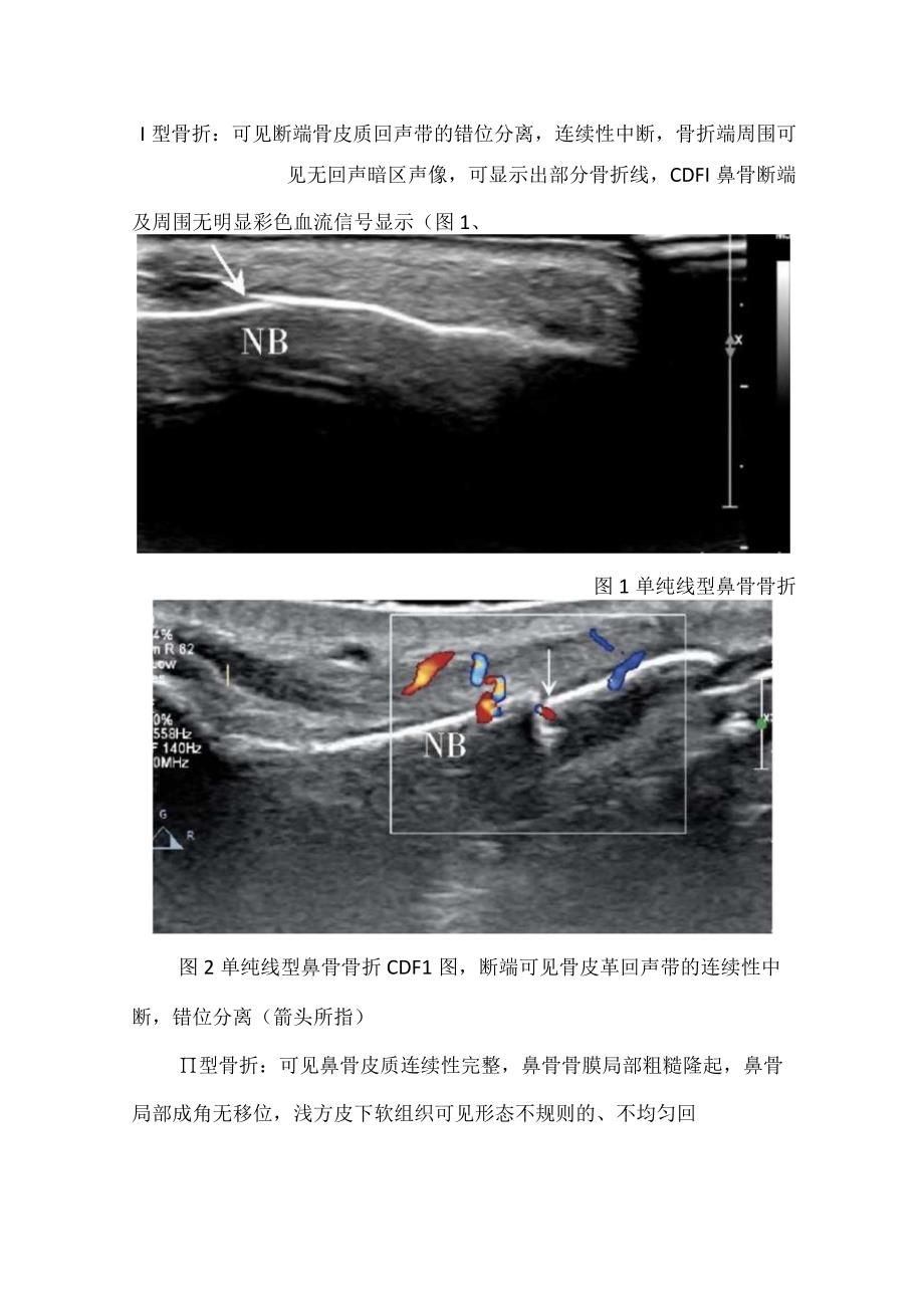 鼻骨骨折检查方法、超声图像分型及超声诊断标准.docx_第2页