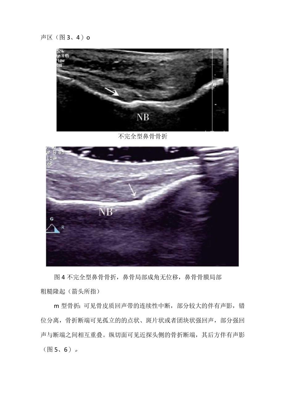 鼻骨骨折检查方法、超声图像分型及超声诊断标准.docx_第3页