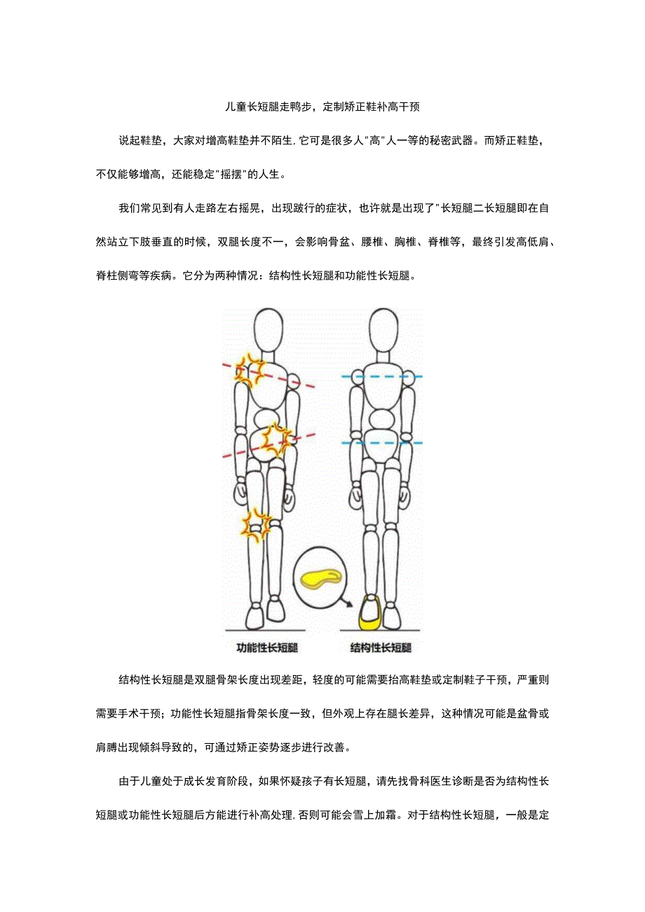 儿童长短腿走鸭步-定制矫正鞋补高干预.docx_第1页