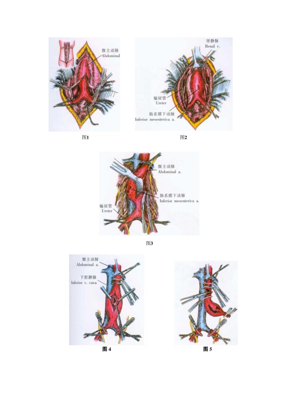 手术图谱资料：腹主动脉瘤切除及人造血管移植术.docx_第2页