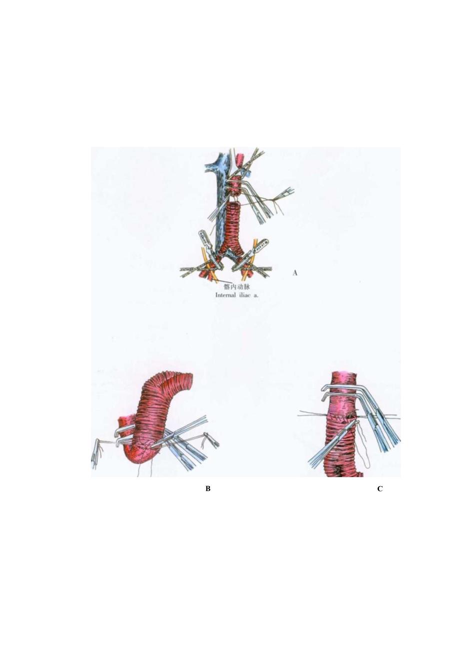 手术图谱资料：腹主动脉瘤切除及人造血管移植术.docx_第3页