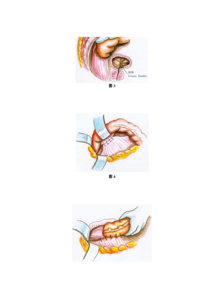 手术图谱资料：Pemberton直肠固定术.docx_第3页