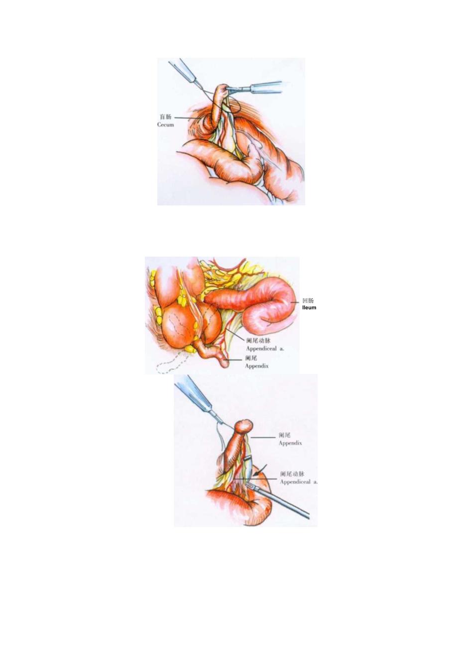 手术图谱资料：腹腔镜阑尾切除术.docx_第3页